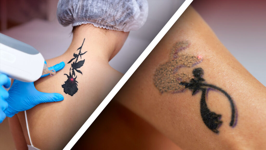 Wat is tatoeageverwijdering met lasers?